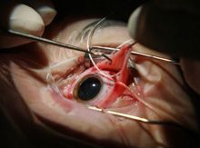 У Київському центрі мікрохірургії ока застосовують новітні хірургічні методики